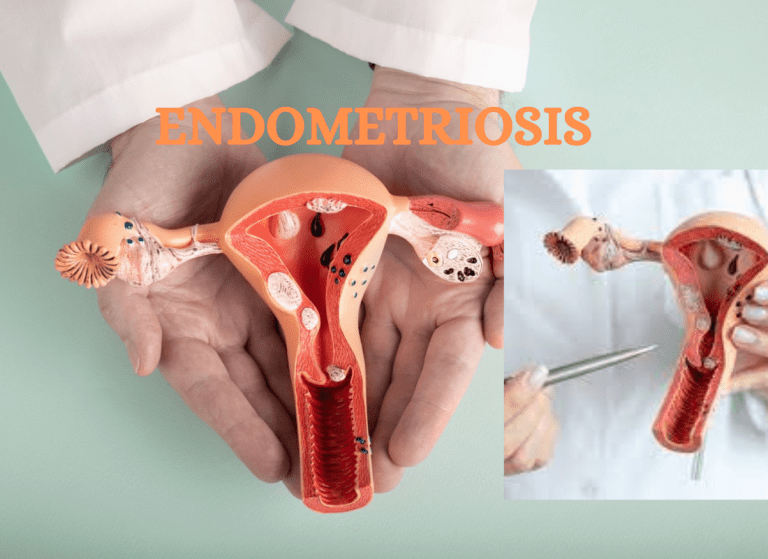 Preventing and Managing Endometriosis: Latest Research and Insights