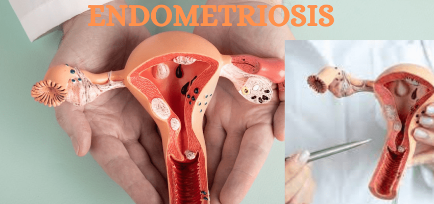 Preventing and Managing Endometriosis: Latest Research and Insights